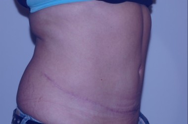 abdominoplasty5,oblique,after