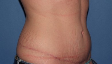 abdominoplasty7,oblique,after