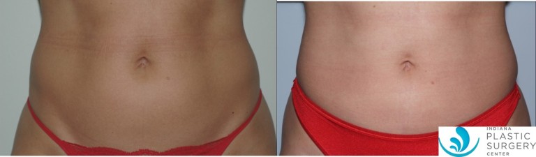 liposuction,abdomen,before and after1