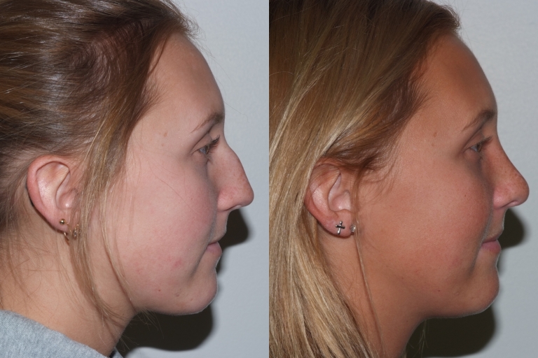 rhinoplasty2,side,before and after