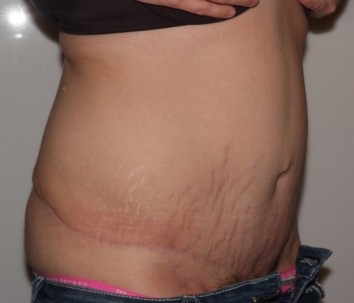 abdominoplasty10,oblique,after